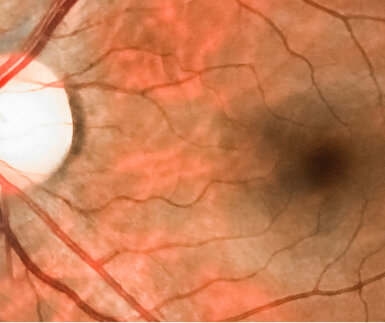 Close up of a medical image of the back of an eye showing micro-veins and vessels with a dark patch towards right hand side of image representing a vein occlusion