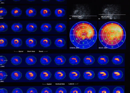 PET Image showing heart and coronary vessels 