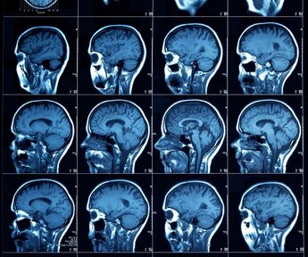 Image showing sliced section CT scan of a human head, showing the cerebral cortex through to the sinus cavities