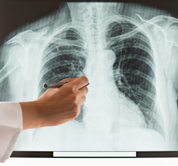 Image showing a chest x-ray