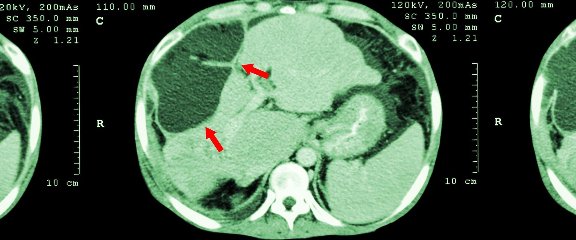 IStock 480196144 Abnormal mass at liver web